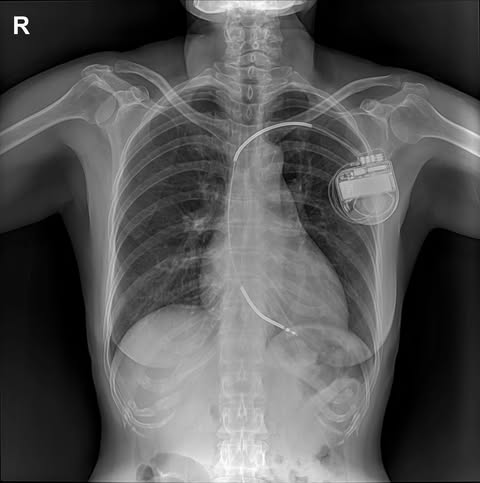 Pacemaker